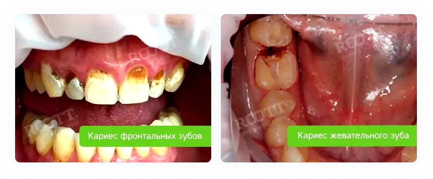 зубы зубы
